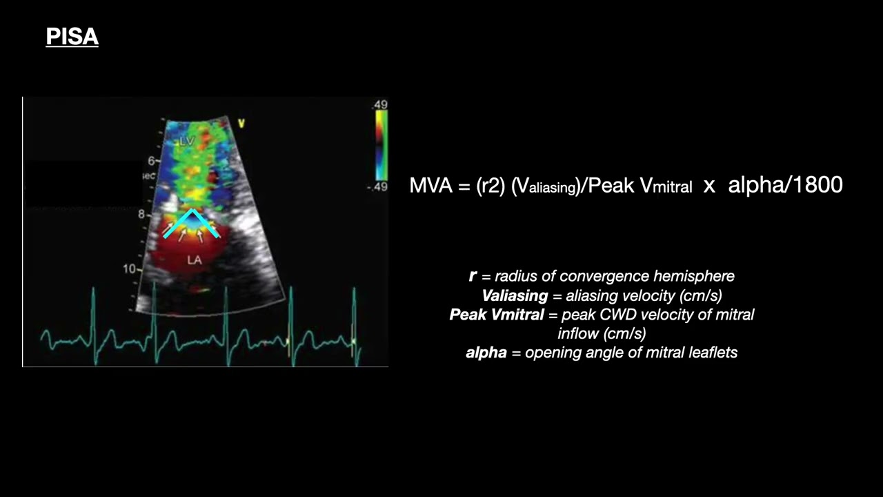 Mitral stenosis