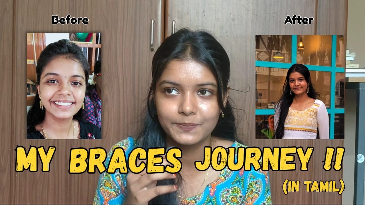 My Braces Journey 2.0 | Complete Before & After Transformation + Honest Experience in TAMIL #braces