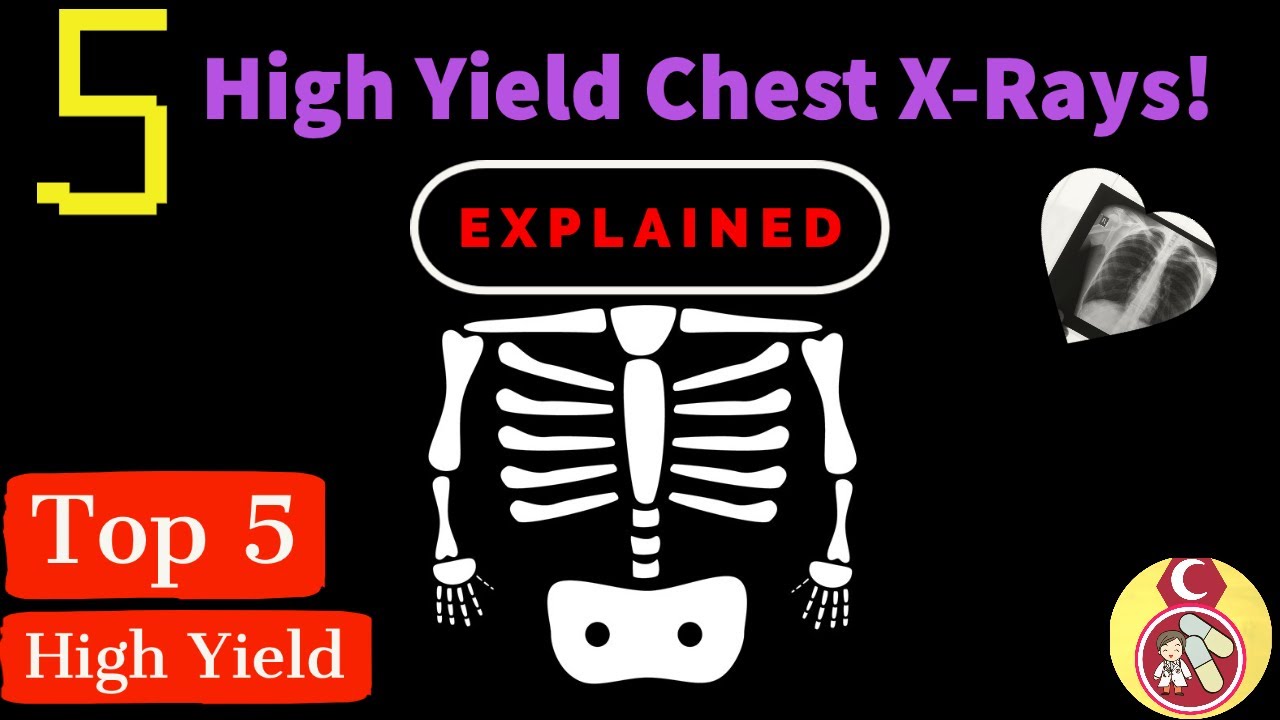 5 High Yield Chest X-Ray Made easy - Plus basic explanations about densities