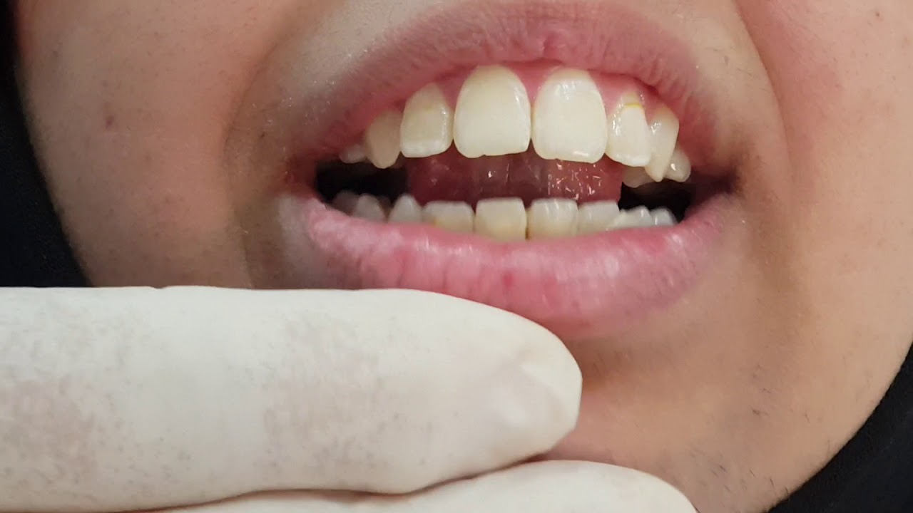 تمارين الشفة واللسان  للحصول ع  اسنان مرتبة . Lip & Tongue Training for Normal Occlusion