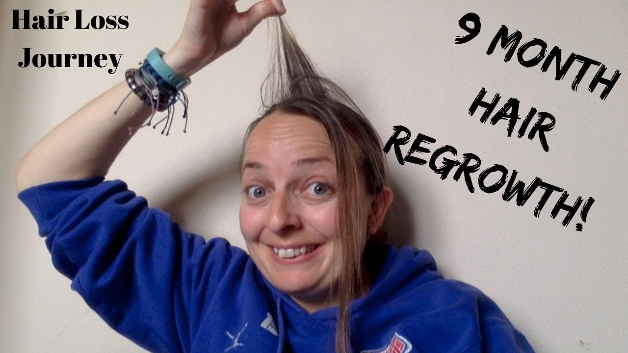 My Telogen Effluvium Recovery Story: 9 Month Update & Hair Regrowth!