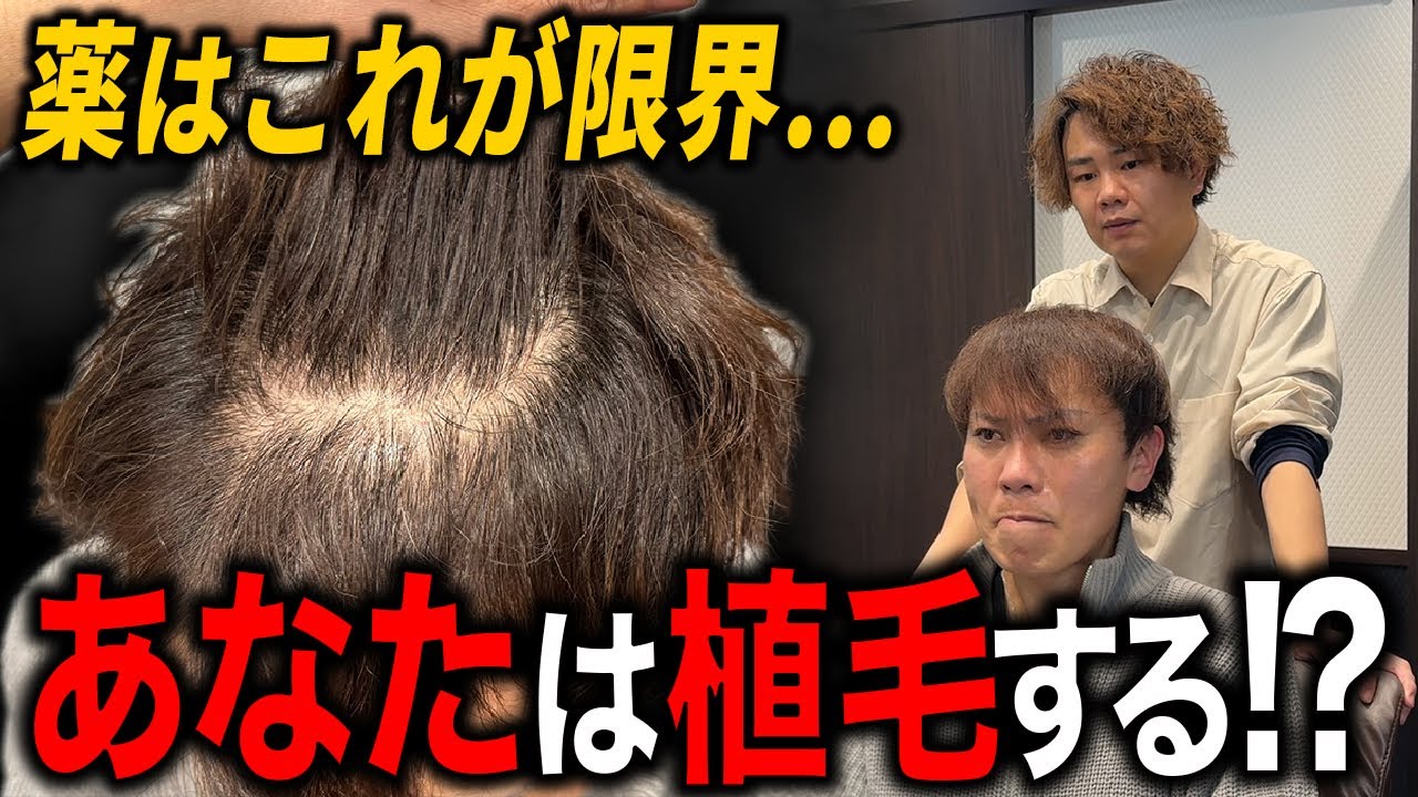 【AGA治療の限界】AGA治療 vs 植毛！本気で薄毛に立ち向かう最良の選択は？