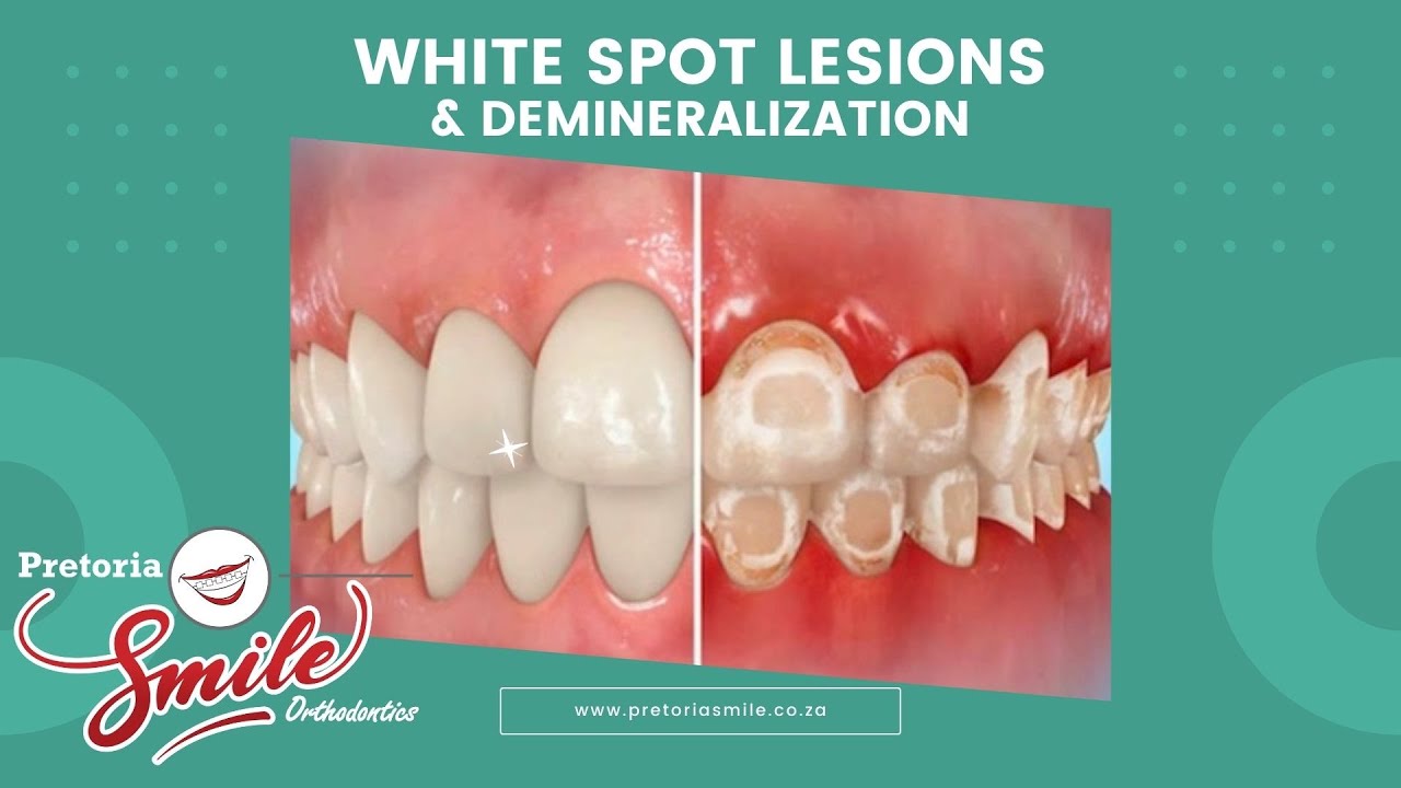 White Spot Lesions & Demineralization