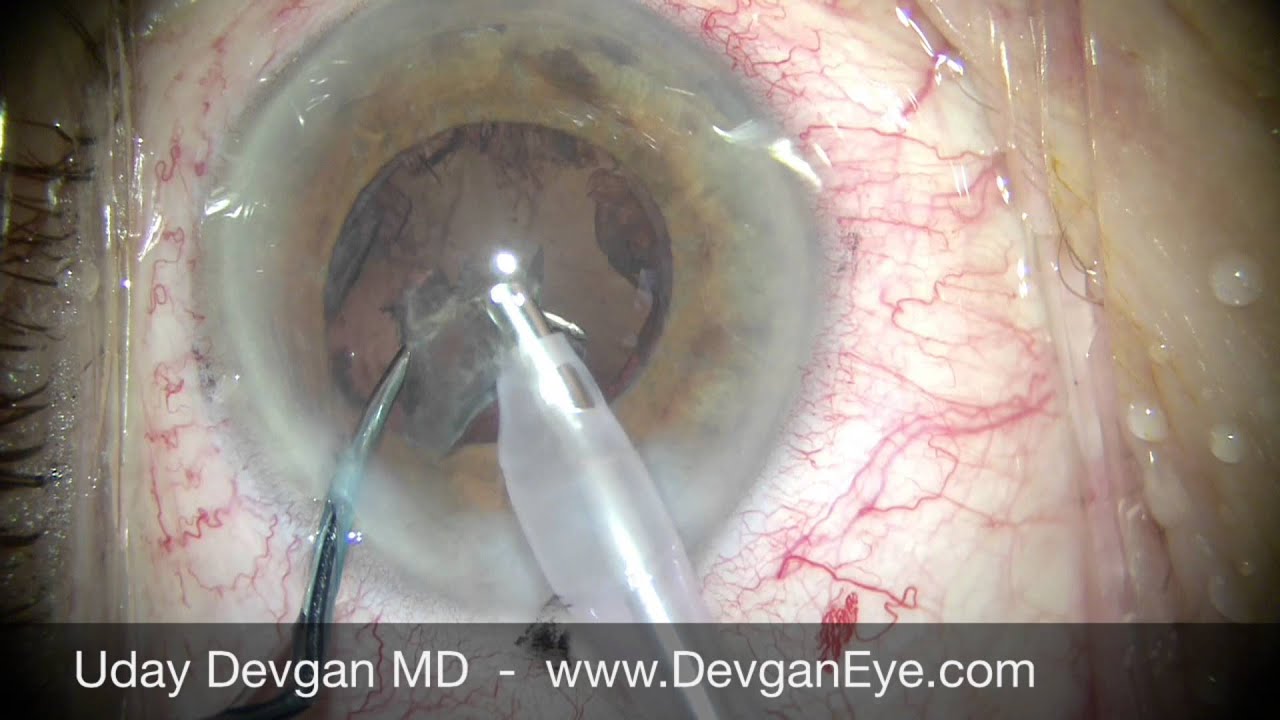 Cataract Surgery in Pseudo Exfoliation with Omidria - Uday Devgan MD
