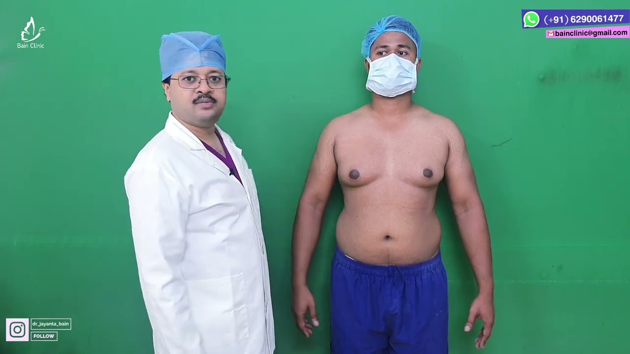Gynecomastia Marking | Kolkata | Male Breast Reduction Surgery | Dr. Jayanta Bain plastic  surgeon