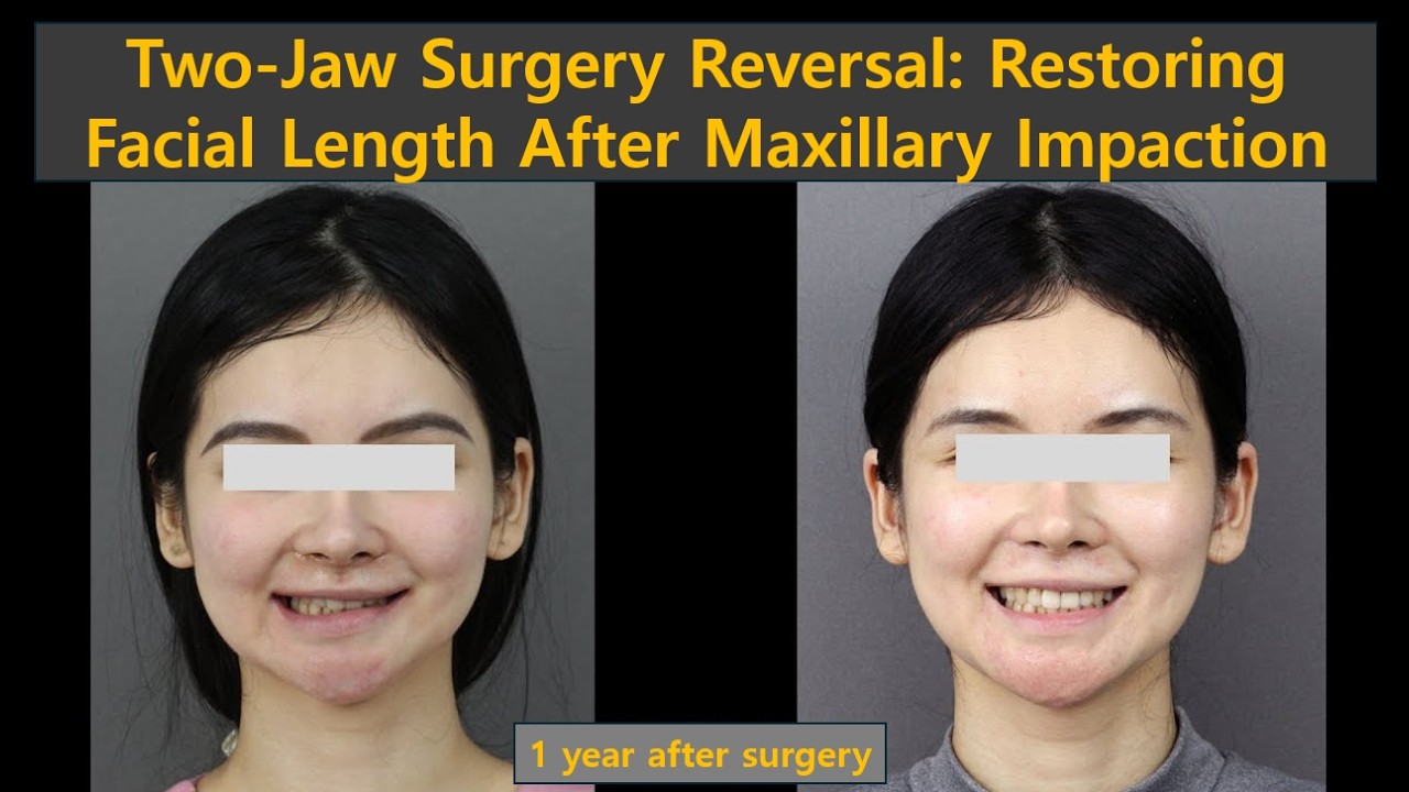 Reversing Double Jaw Surgery: 4.5mm Maxillary Lowering & Counter-Clockwise Rotation Real Case Review