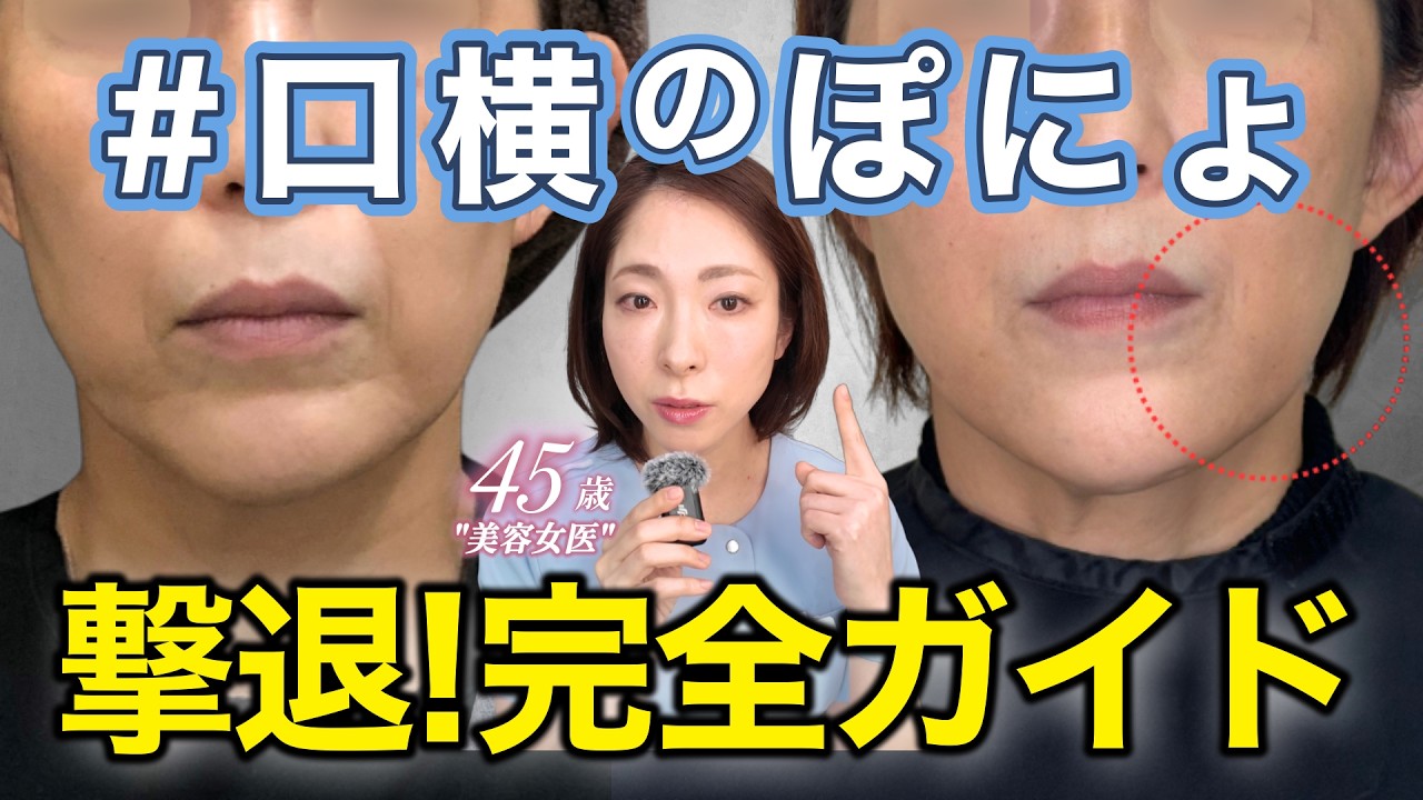 口横のぽにょを解消!4つの原因と治療法を医師が徹底解説!!