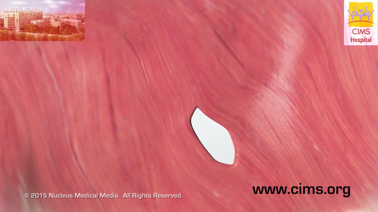 Congenital Diaphragmatic Hernia Repair (Gujarati) – CIMS Hospital