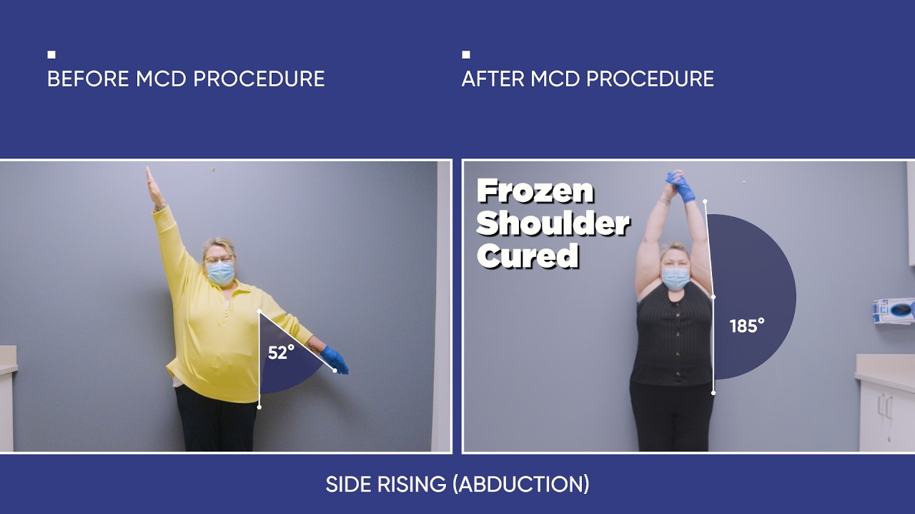 Frozen Shoulder After a Military Injury — Tammy’s 2-Day Recovery Story
