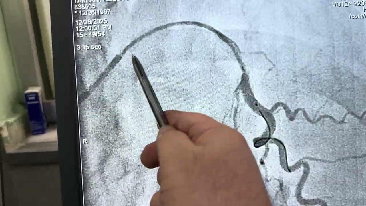 Primary PCI on LAD