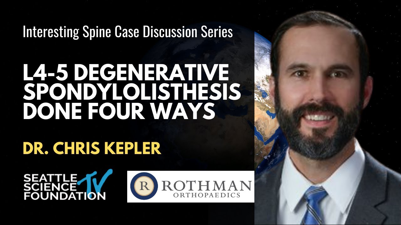 L4-5 Degenerative Spondylolisthesis Done Four Ways - Chris Kepler, M.D.