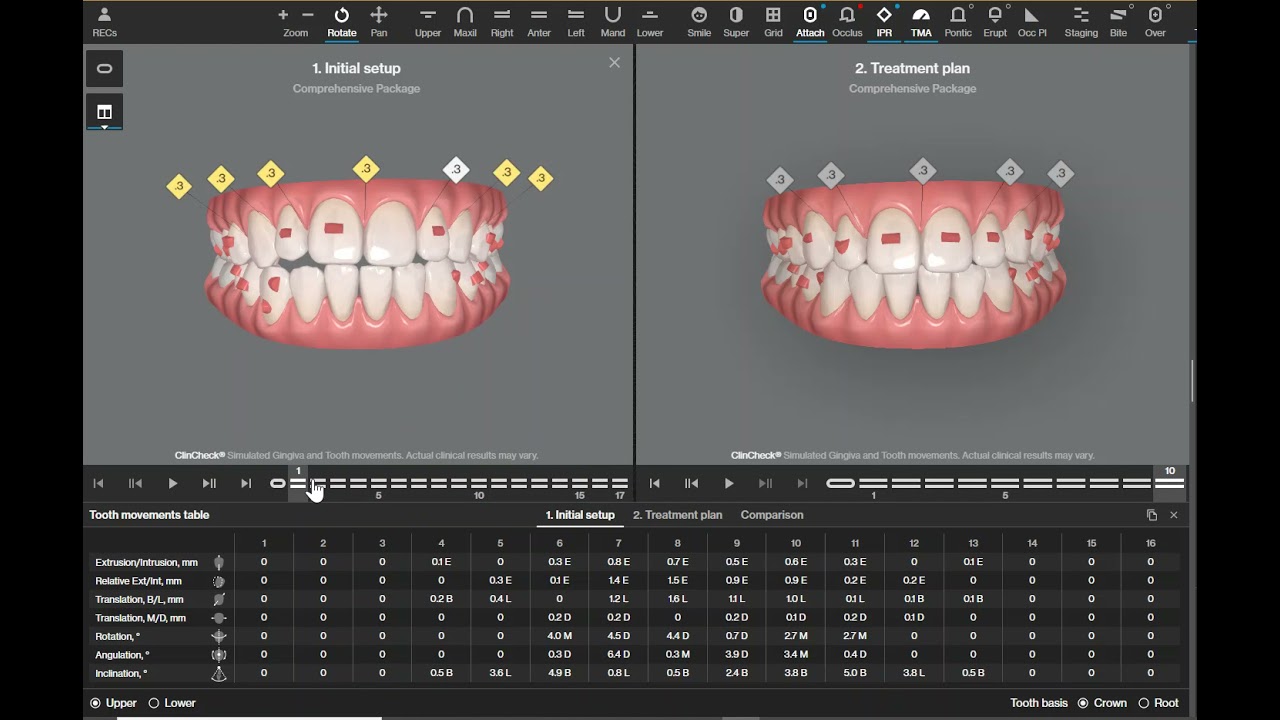 Invisalign ClinCheck - Need for extrusion attachments
