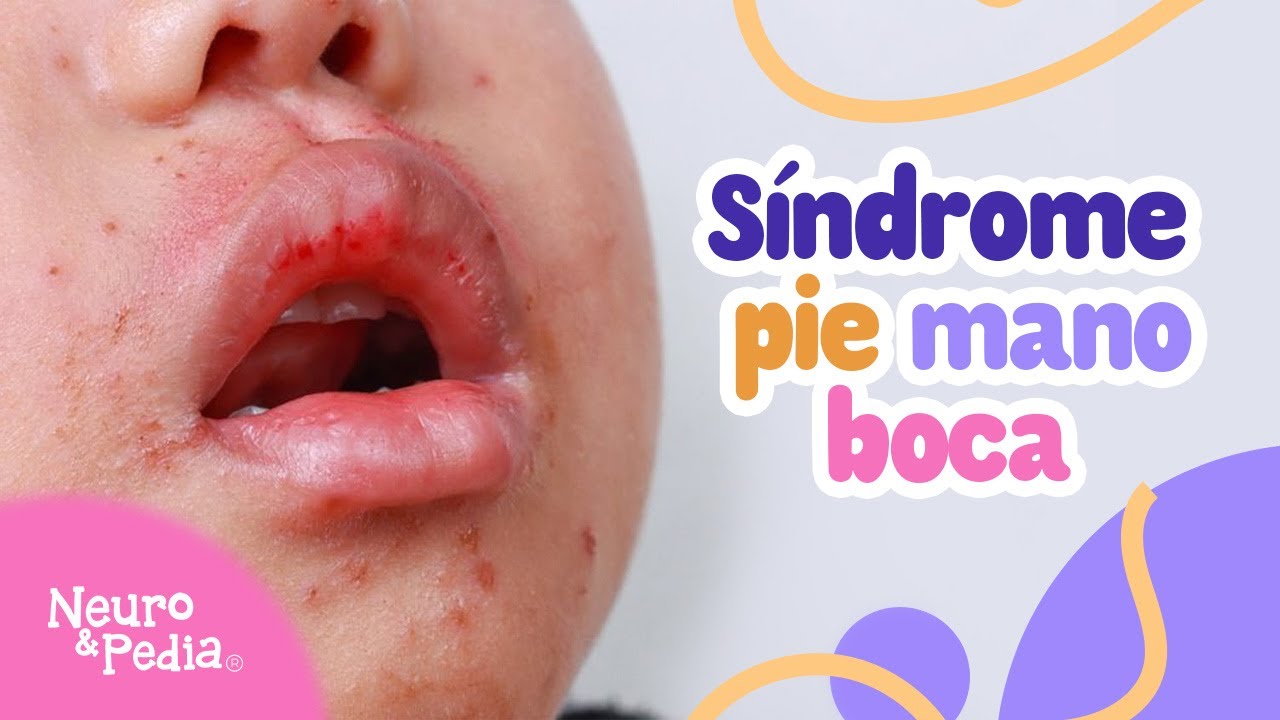 🦠 ¿Qué es la enfermedad mano-pie-boca?