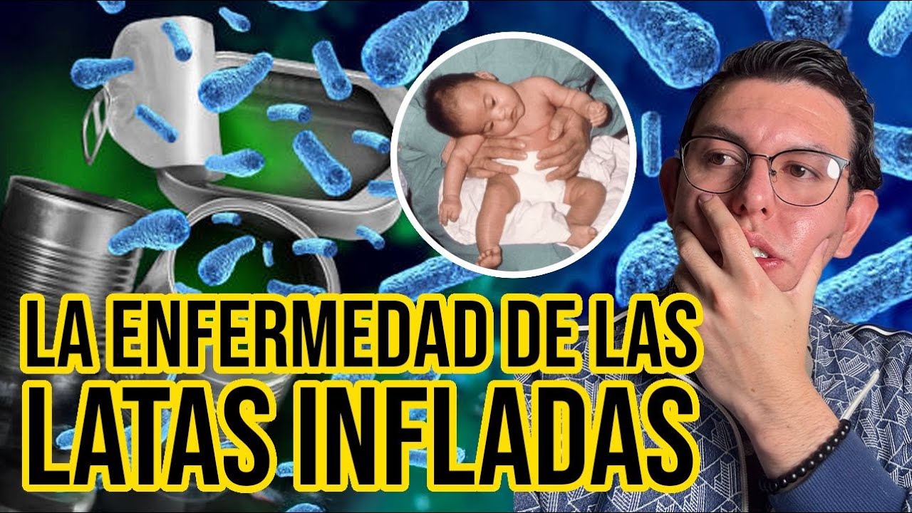 Niño MENOR de 6 meses QUEDA PARALIZADO por COMER MIEL (Botulismo) |DrPoloGuerrero