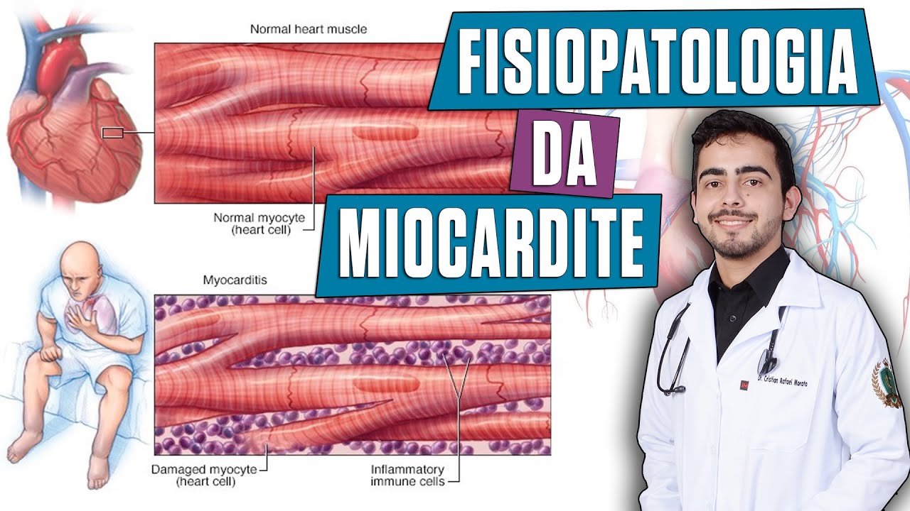 Fisiopatologia da Miocardite - (PORTH Capítulo 32)