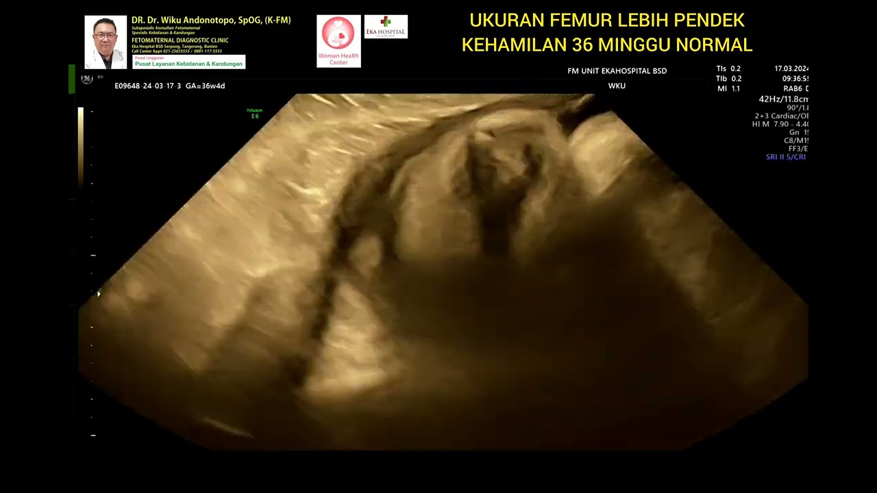 Femur lebih pendek dari usia kehamilan 36 minggu normal