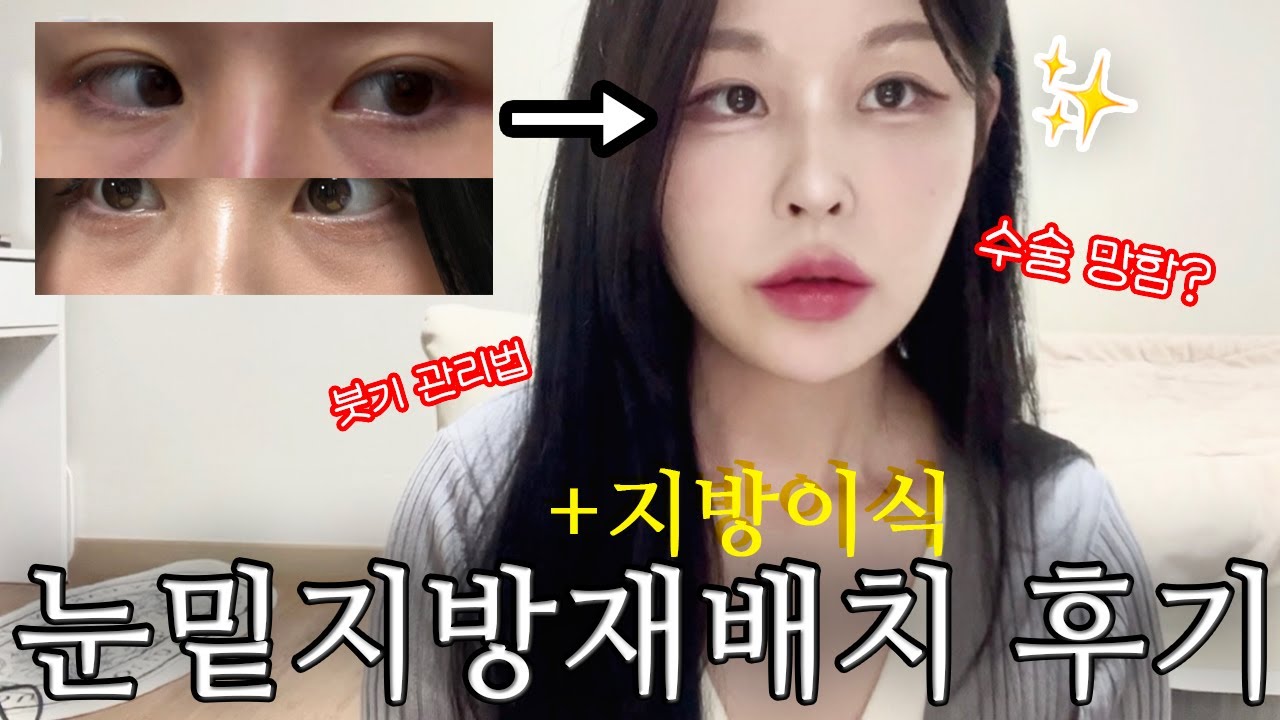눈밑지방재배치+지방이식 브이로그🔥| 첫 성형수술.. 눈밑꺼짐, 다크서클, 붓기관리, 주의사항, 멍