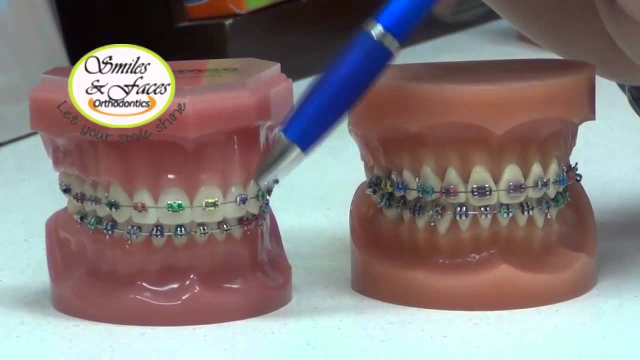 Braces type made simple- Introducing Metal Mini-braces with Colours