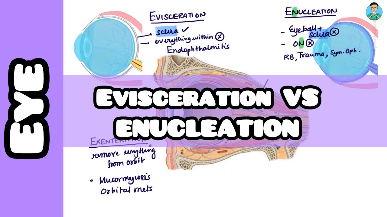 Evisceration VS Enucleation: eye removal surgery for #inicet #usmle #neetpg #fmge #firstaidusmle