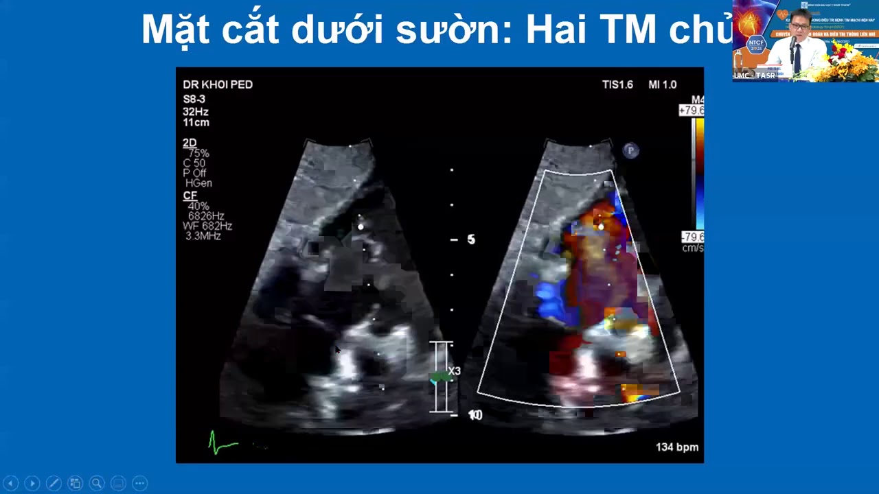 Một số mẹo trong siêu âm đánh giá Thông liên nhĩ