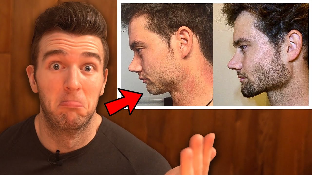 More Misinformation In Connor Murphy's 30 Day MEWING Transformation | FASTING DOESN'T GROW YOUR JAW!