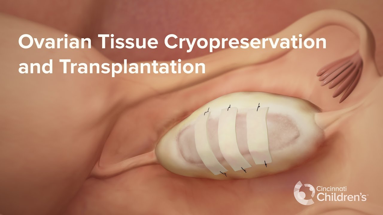 Medical Animation: Ovarian Tissue Cryopreservation & Transplantation | Cincinnati Children's