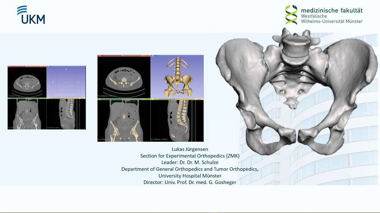 3D Slicer Tutorial: Pelvic Bone Segmentation