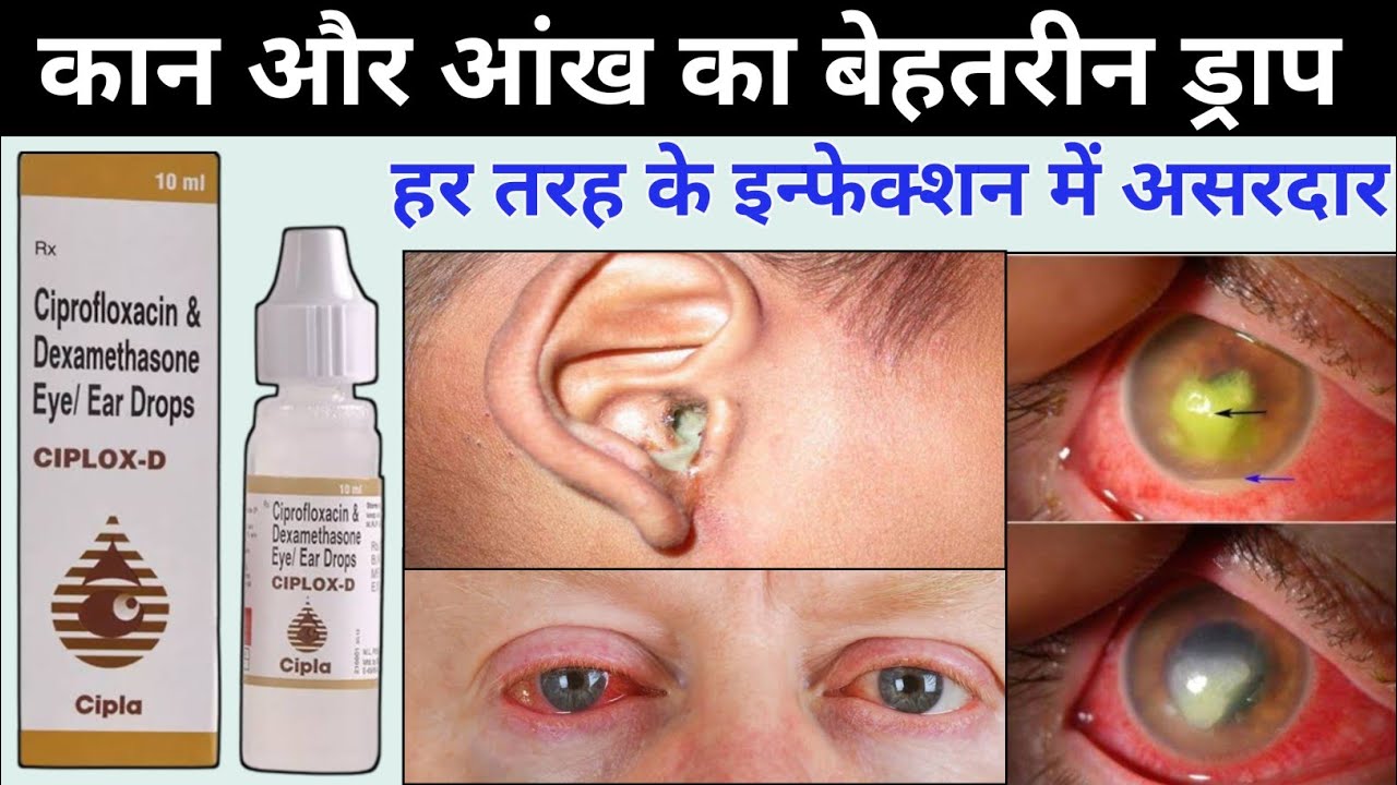 ciplox d eye ear drops || ciprofloxacin dexamethasone eye ear drops ciplox d uses in hindi