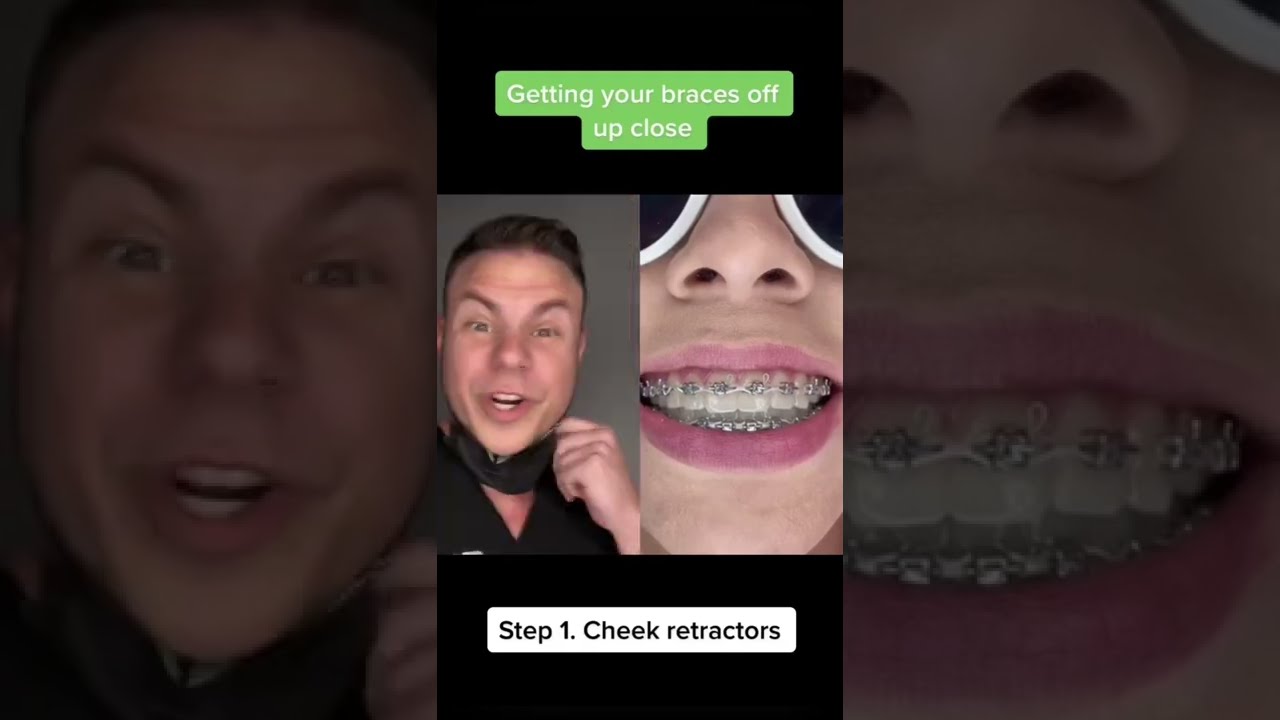 POV: You&rsquo;re Getting Your Braces Off #shorts