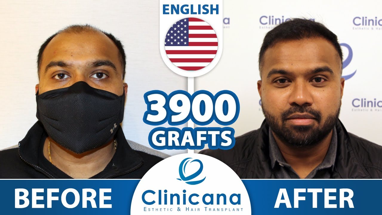Roy's Hair Transplant Journey in Istanbul Turkey | Clinicana reviews