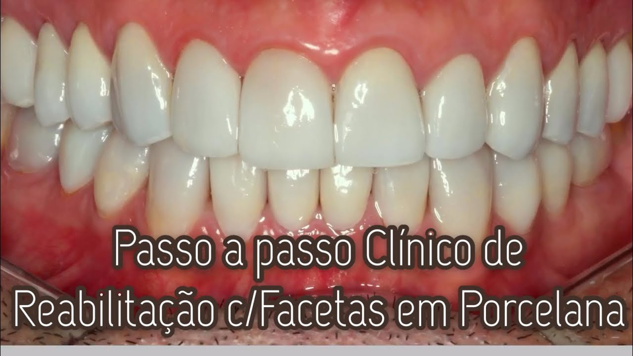 #141 FACETAS EM PORCELANA (PASSO A PASSO DETALHADO)