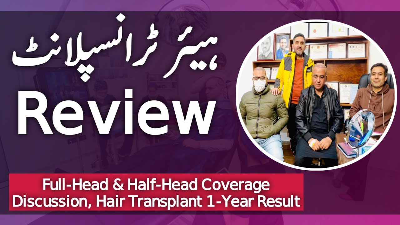 ✅ SHOCKING 1 YEAR HAIR GROWTH! Full Head Transplant Transformation | HONEST Review [2024]