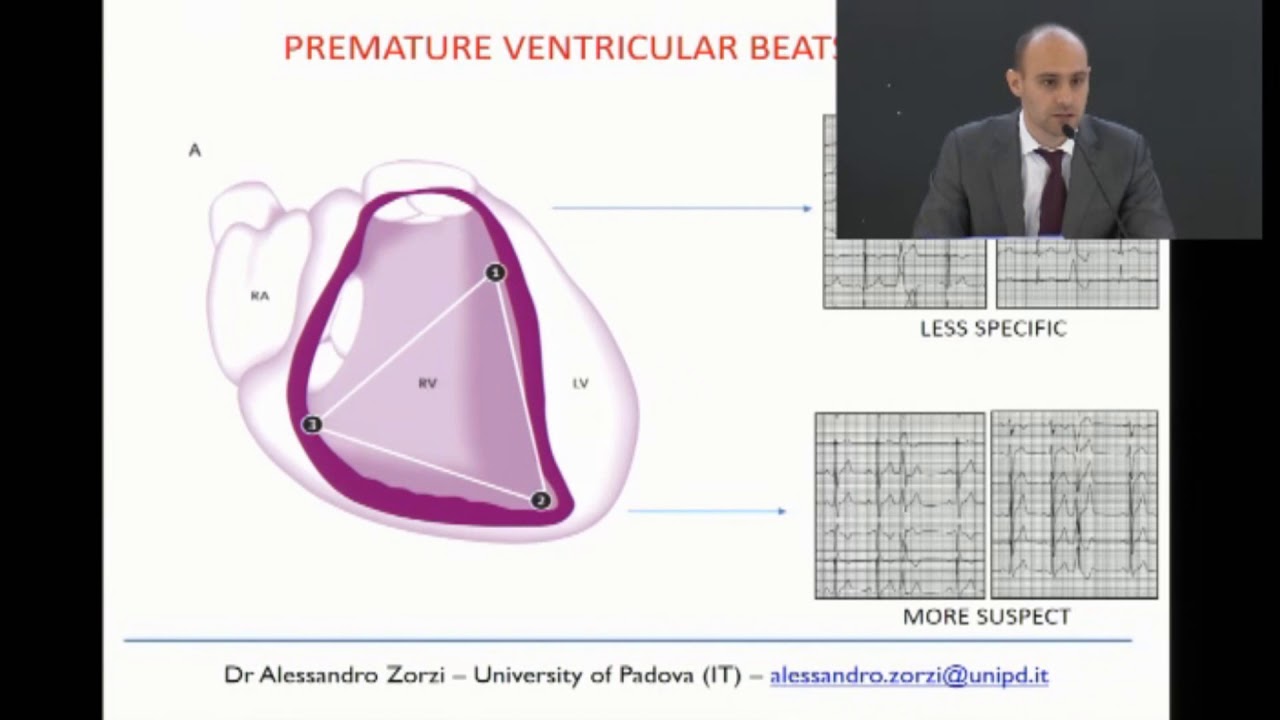 Arrhythmogenic (right ventricular) cardiomyopathy A.Zorzi