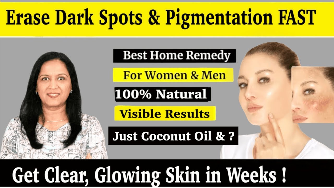 Remove Dark Circles, Dark Spots & Hyperpigmentation Marks With These 5 Remedies (Permanent Solution)