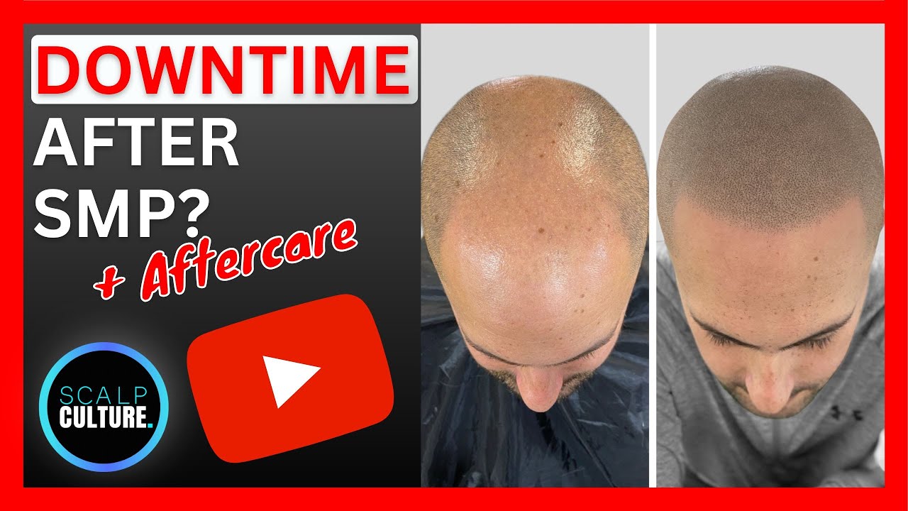 Downtime After Scalp Micropigmentation? + Aftercare Advice