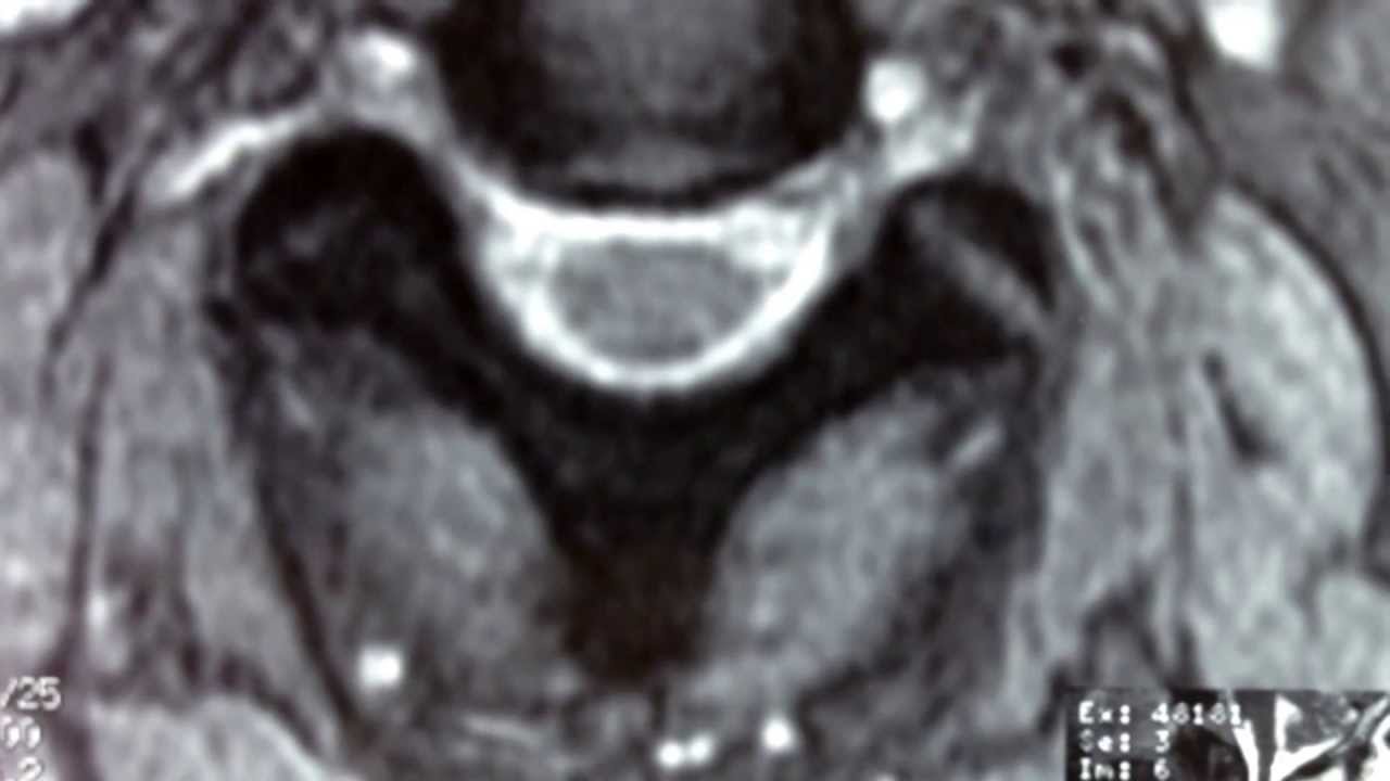 Neck motion following a C3T2 spinal fusion