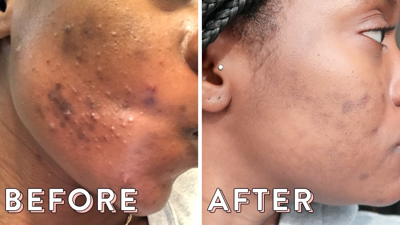 Clearing My Hormonal Acne With Spironolactone | Skin Update #3