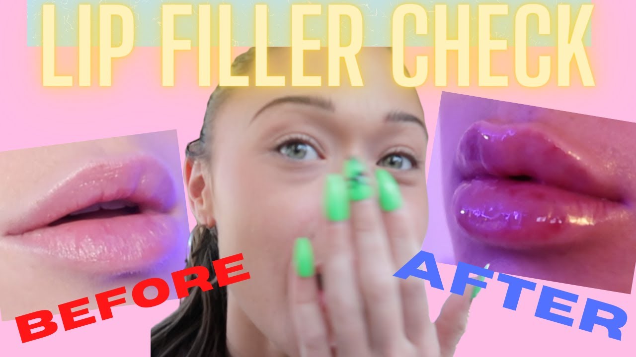 I GOT LIP FILLER