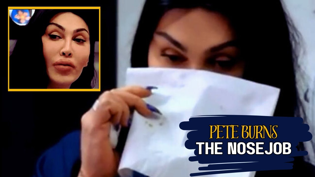 Dead Or Alive | Pete Burns: The Nose Jobs