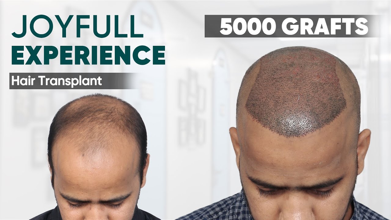 Hair Transplant in Delhi (HX-WGHR) | Best Results & Cost of Hair Transplant in Delhi