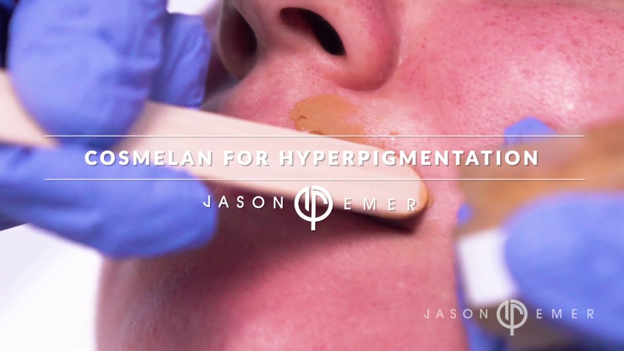 Cosmelan Treatment For Hyperpigmentation | Cosmelan Before and After | Depigmentation Treatment