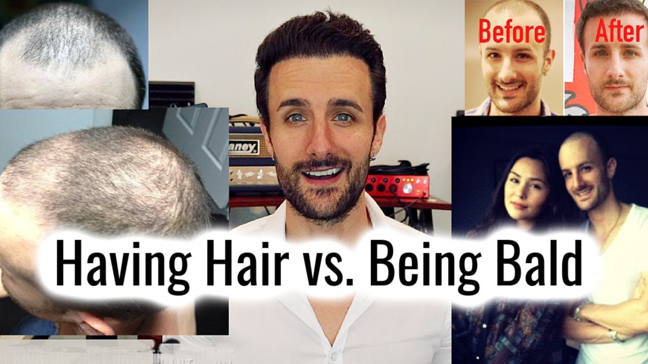 Having Hair vs. Being Bald - My Experience