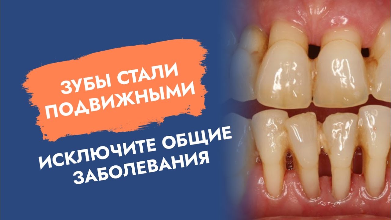 Зубы стали подвижными. Исключите общие заболевания!