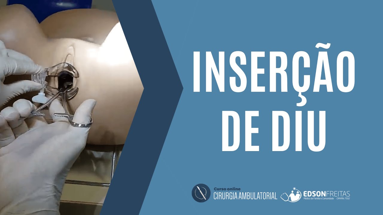 Inser&ccedil;&atilde;o de DIU (Intrauterine device - IUD)