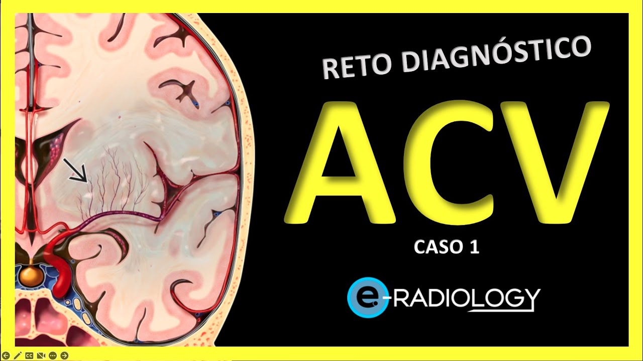 ECV 🧠 - Caso 1 | Enfermedad CEREBROVASCULAR | Explicación de SIGNOS RADIOLÓGICOS | Isquemia CEREBRAL
