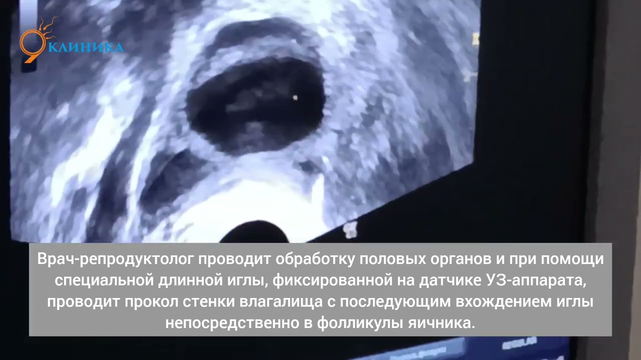 Трансвагинальная пункция фолликулов.