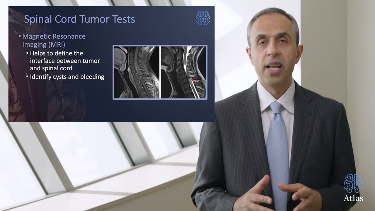 Spinal Cord Tumor: Symptoms, Causes, Diagnosis, and Treatment - Aaron Cohen-Gadol, M.D.
