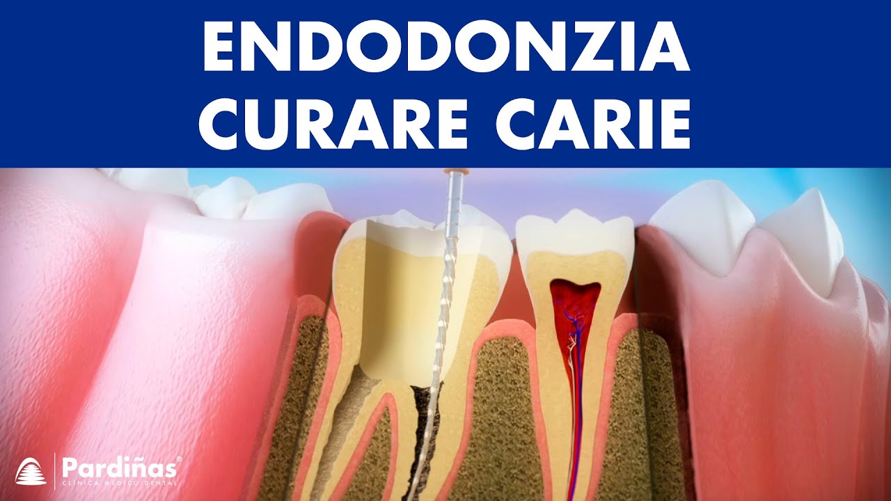 Endodonzia – Curare carie profonda ©