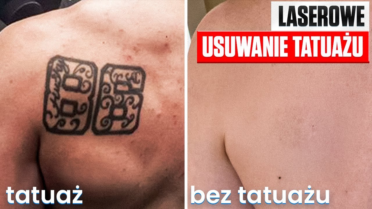 USUWANIE TATUAŻU – Kompletny przewodnik od A do Z