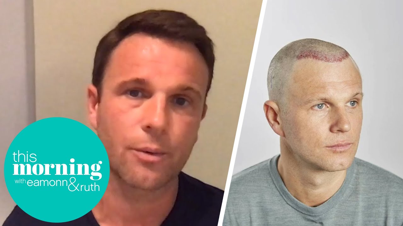 I’ve Spent £40,000 On Fixing My Botched Hair Transplant And Now I’m Warning Others | This Morning